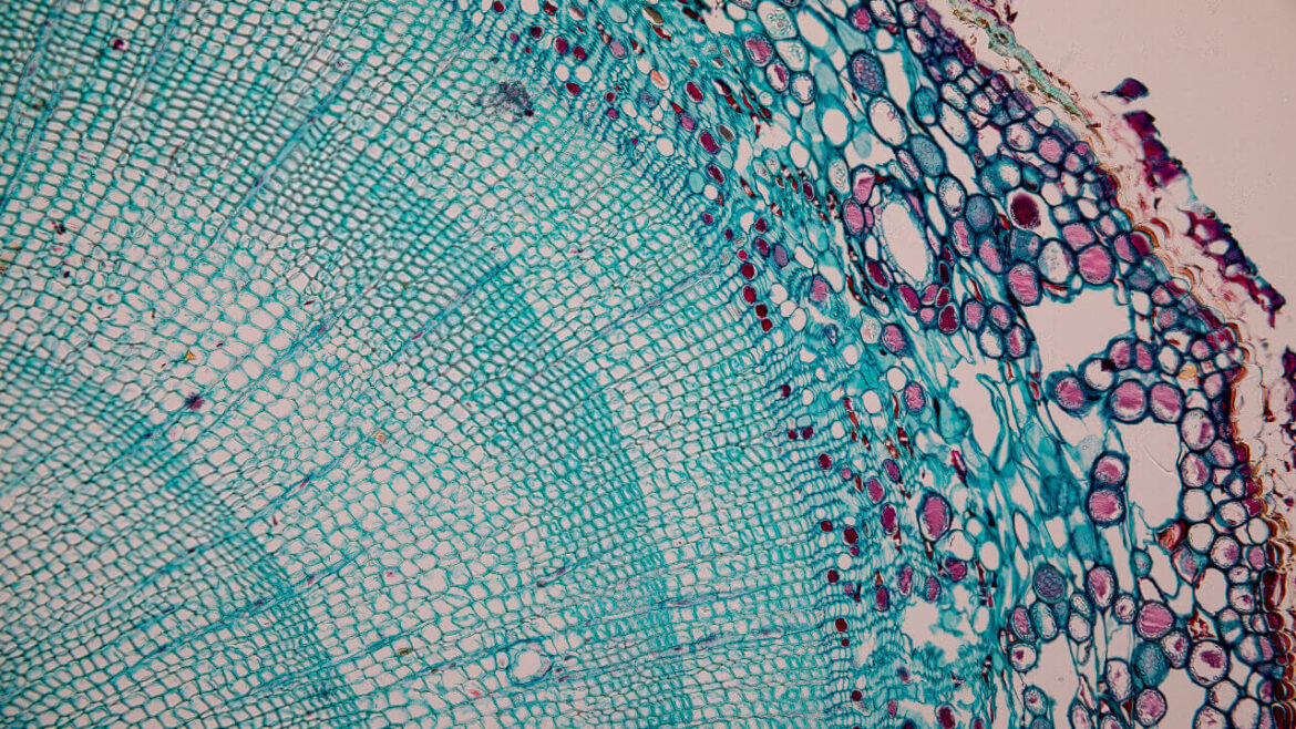 Revolutionary Stroke Recovery – How Umbilical Cord Blood is Changing the Game